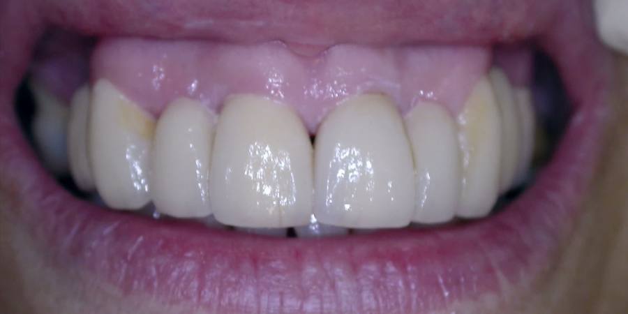 After: Crowns and restorative care