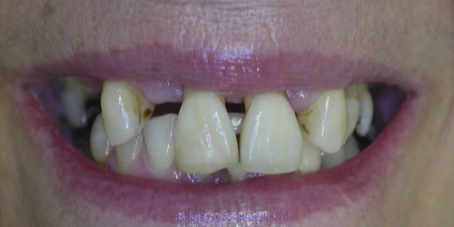 Before: Crowns and restorative care