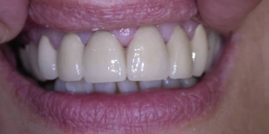After: Cosmetic treatment of front teeth