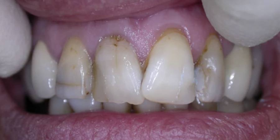 Before: Cosmetic treatment of front teeth