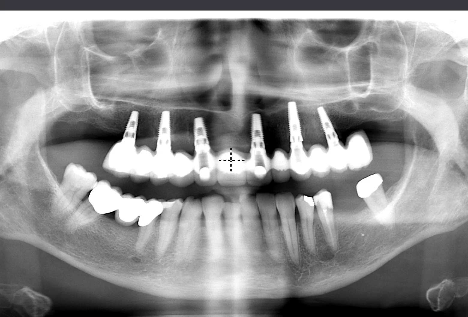 Dental implants at Frölunda Tandläkarna